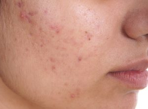 Close up of cheek with acne