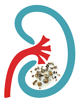 How can fostering good gut bacteria help reduce my kidney stones?