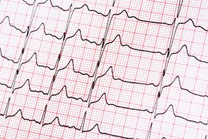 atrial fibrillation