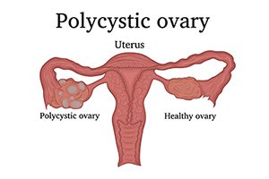 Natural treatment of PCOS