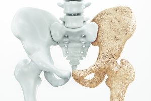 ‘A Perfect Storm for Broken Bones’ or a perfect marketing pitch for osteoporosis drugs?