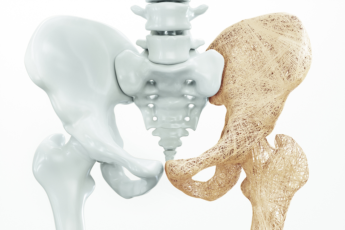 ‘A Perfect Storm for Broken Bones’ or a perfect marketing pitch for osteoporosis drugs?