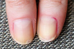 Ask Leyla: What’s causing my brittle nails?