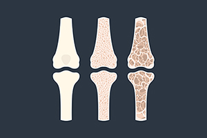Osteoporosis: New tests and new concerns about drugs