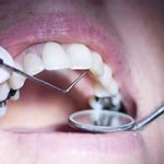 Should I have metal dental fillings removed to reduce mercury exposure?