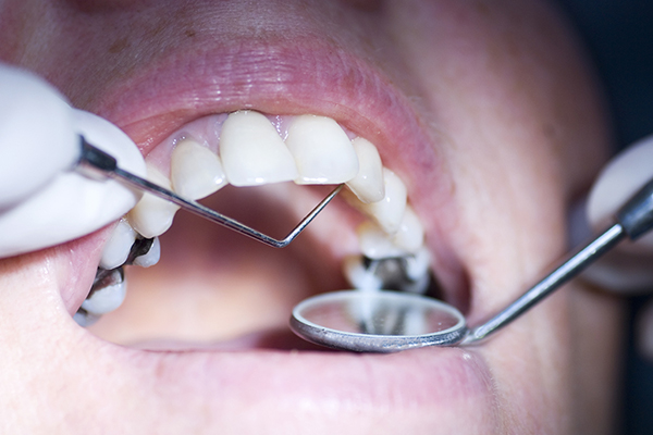 Should I have metal dental fillings removed to reduce mercury exposure?