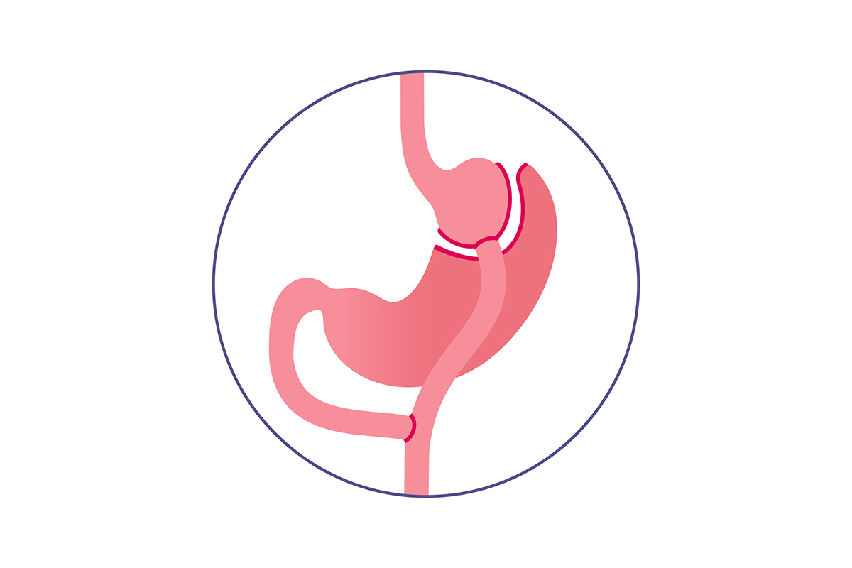 Illustration of gastric bypass