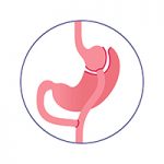 Illustration of gastric bypass