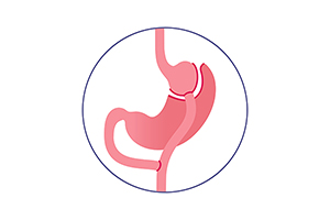 Illustration of gastric bypass