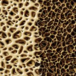 Split screen depiction of healthy bone versus bone with osteoporosis