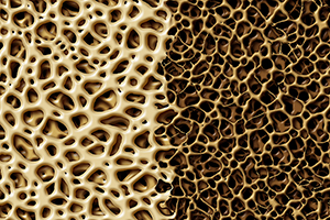 Split screen depiction of healthy bone versus bone with osteoporosis