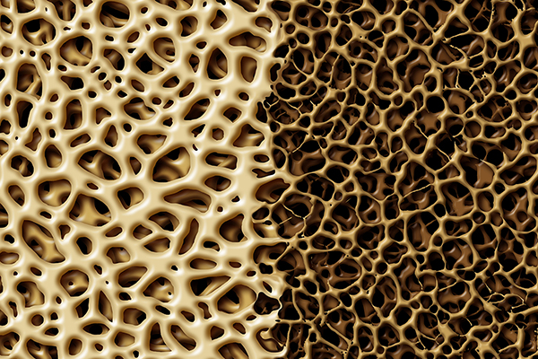 Split screen depiction of healthy bone versus bone with osteoporosis