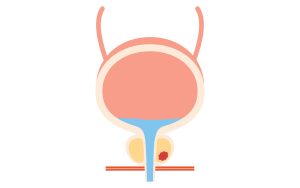 Medical Illustration of Prostate, Stage 2 Prostate Cancer