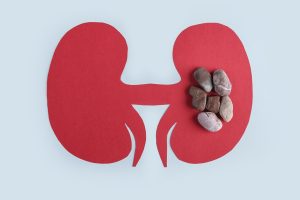 Red paper cutout of kidneys on blue background with small stones piled top of the right kidney to represent kidney stones